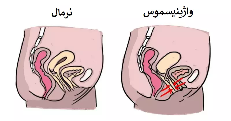 واژینیسموس