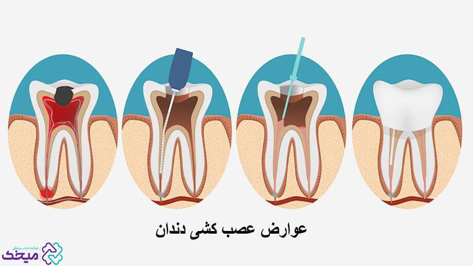 عوارض عصب کشی دندان